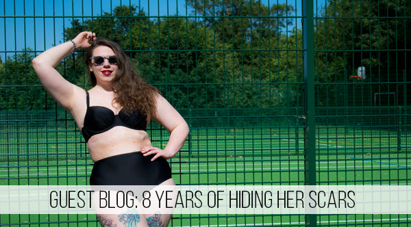 Guest Blog: 8 Years Of Hiding Her Scars Hannah Shows Off Her Beach Body